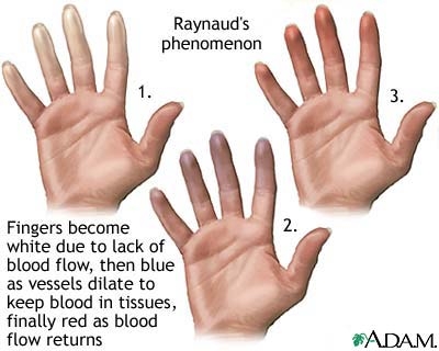 Raynaud disease (symmetrical gangrene; symmetrical asphyxia)