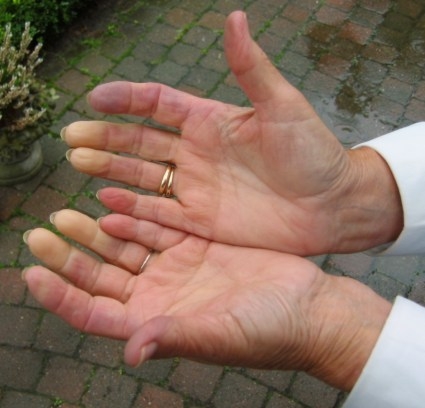 Boala raynaud