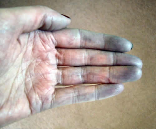 Raynaud (sindromul)