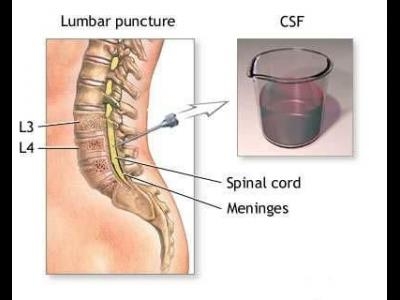 Afectiunile neuronului motor, inclusiv scleroza laterala amiotrofica(sla)