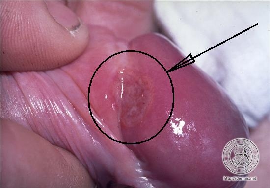 sifilisul penisului semne din care dispare erecția
