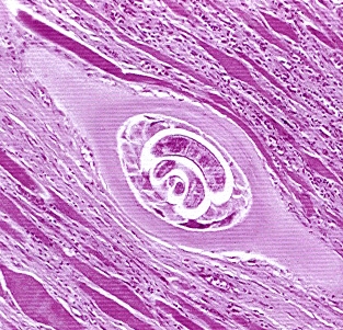 Trichineloza