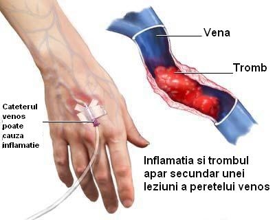 imagini tromboflebita