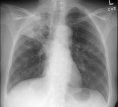 Sechelele tuberculozei primare cu localizare pulmonara