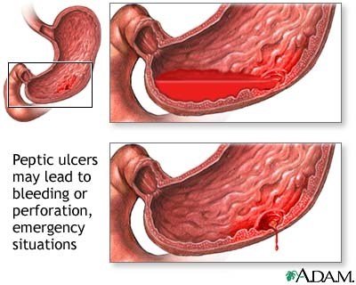 Ulcer (duodenal, hemoragie)