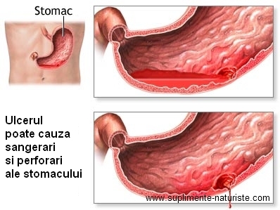 Ulcerele de gamba