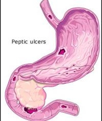 Ulcerul gastroduodenal