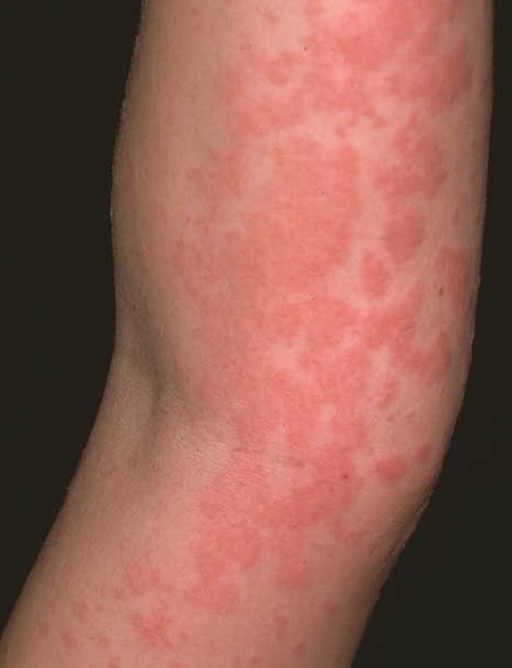 Urticaria edemul quincke