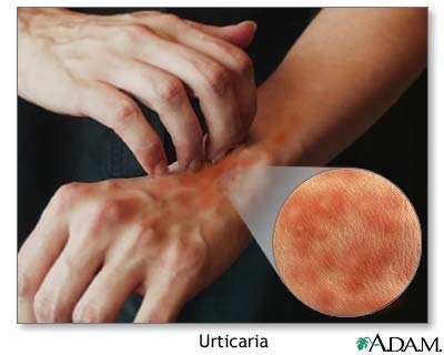 imagini urticaria