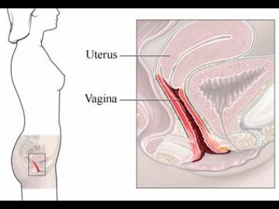 Vaginita (vulvovaginita)