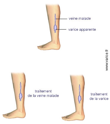 Varice esofagiene. hipertensiunea venei porte