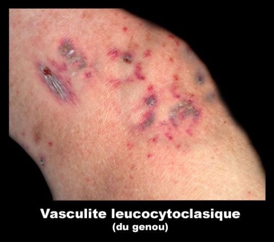 Vasculite imune